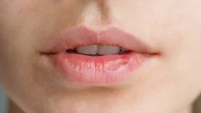 На губах белый налет по утрам: почему появляется, способы лечения | Dental  Art