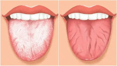 Налет на языке у взрослых — причины, цвета, признаки заболеваний в статье  на Startsmile.ru