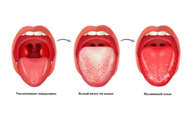 Налет на языке – причины, симптомы, лечение 👅 Как убрать белый налет на  языке 😛 | CIS