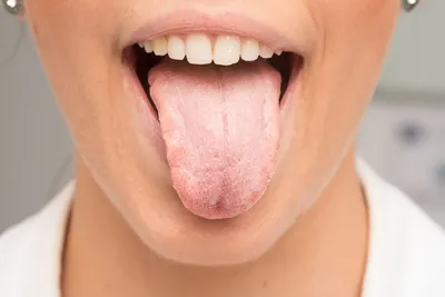 Белый налет на языке - что это значит и как от него избавиться? | Полезные  советы - блог стоматологической клиники Complex Dent в Киеве