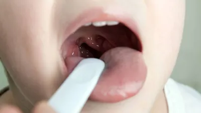 Белый налет на языке у взрослого или ребенка - причины появления, лечение  заболеваний, обратиться к врачу, если обложен язык