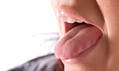 У каждого пятого – сыпь на языке: новый симптом коронавируса