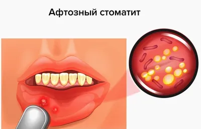 На губах белый налет по утрам: почему появляется, способы лечения | Dental  Art