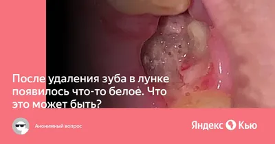 После удаления зуба в лунке появилось что-то белое. Что это может быть?» —  Яндекс Кью