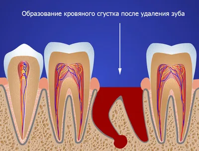 Альвеолит лунки: причины, симптомы, лечение