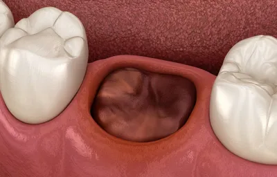 Киста после удаления зуба: кто виноват и как лечить заболевание | Dental Art