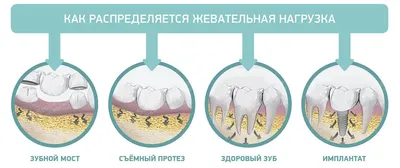 Осложнения после удаления зуба: боль, отек, онемение языка, альвеолит