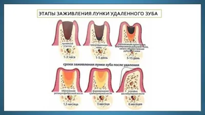 Что делать после удаления зуба — стоматологическая клиника Эталон Ростов