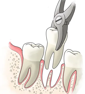 Удаление зубов без боли, цена Ульяновске Diamond Dent