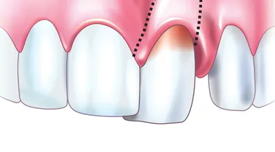 Прыщ на десне: причины, осложнения, лечение — клиника Доктора Федорова