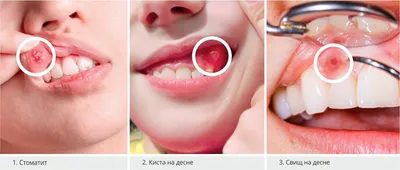 Белый прыщ на гланде и на десне - Вопрос стоматологу - 03 Онлайн