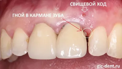 Гнойник (прыщ, абсцесс зуба) на десне – что делать, лечение нарыва на десне