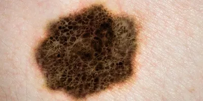 5 признаков рака кожи, которые на первых порах многие игнорируют. |  ПРАВДИВАЯ ОНКОЛОГИЯ | Дзен