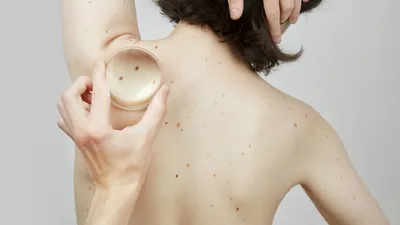 Рак кожи щеки | NEOPLASTY