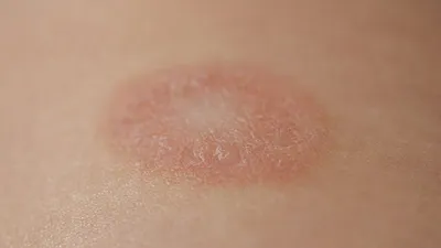 Рак кожи