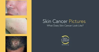 Фотографии рака кожи - Фонд рака кожи