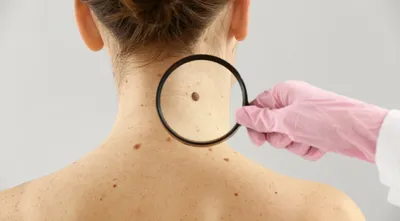 Рак кожи: симптомы, диагностика, лечение, стадии и профилактика онкологии