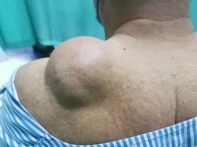Рак кожи, диагностика и лечение в Сургуте | МЦ Докторплюс