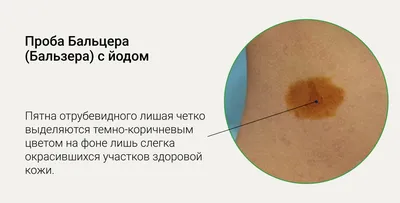 Розовый лишай - Дерматологическая патология - Справочник MSD  Профессиональная версия