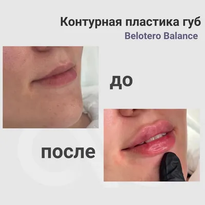 Ассиметрия губ и лица в целом... - Ksenia Pasko Cosmetology | Facebook