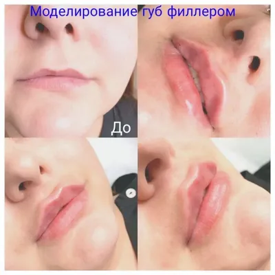 Лаура -фэйс-мастер na Instagrame:: \"Хочу увеличить губы! 💉 А это БОЛЬНО?😢  А я не буду выглядеть как \"УТКА\"?🦆 А это НЕ ОПАСНО, какие ПОБОЧНЫЕ  ДЕЙСТВИЯ? А НАСКОЛЬКО ХВАТИТ эффекта? Я постоянно сталкиваюсь