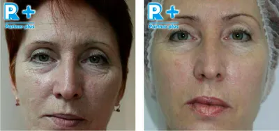 Биоревитализация кожи вокруг глаз: фото до и после, препараты - клиника  Абсолют Мед