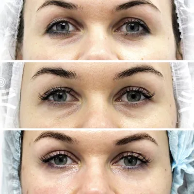 Биоревитализация кожи вокруг глаз. Инъекции гиалуроновой кислоты -  «Требуется далеко не одна процедура. Могут быть синяки.» | отзывы