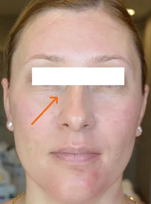 Биоревитализация кожи вокруг глаз: цена, отзывы, фото до и после
