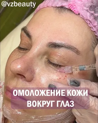 Коррекция носослезной борозды филлерами: цены в Москве | Удаление  носослезной борозды в клинике BeautyWay Clinic