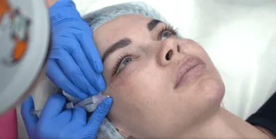 Биоревитализация Вокруг Глаз💉 Биоревитализация зоны вокруг глаз —  лечебно-эстетическая процедура обновления клеток с помощью инъекций… |  Instagram