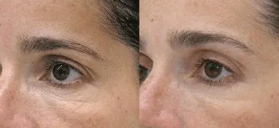Биоревитализация кожи вокруг глаз отзывы, препараты, фото. Биоревитализация  под глазами отзывы. Биоревитализация глаз отзывы.