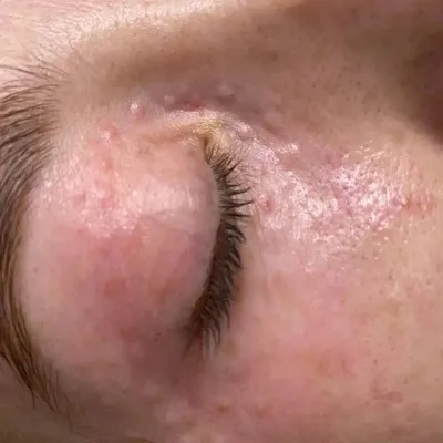 Эффект фотошопа -это все биоревитализация зоны вокруг глаз 💉 Результат  после первой процедуры! Уплотняется кожа, уходят мелкие морщинки… |  Instagram