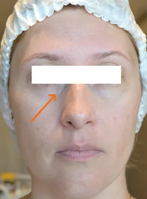 Биоревитализация препаратом Revi Eye Correction - «Биоревитализация кожи вокруг  глаз препаратом Реви Ай Коррекшн | Курс из 4- процедур | Ощущения,  впечатления, внешний вид после процедуры» | отзывы