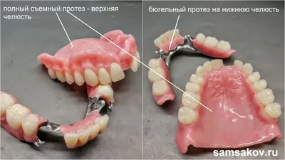 Доступная цена на бюгельный протез на верхнюю/нижнюю челюсть