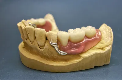 Установка бюгельного протеза на нижнюю челюсть в Москве: цены, фото до и  после, отзывы | Стоимость установки бюгельного протеза на нижнюю челюсть в  клинике Seline