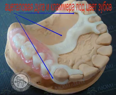 Бюгельный съемный протез на кламмерной фиксации. -