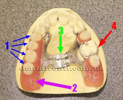 Бюгельный протез зубов – цена на верхнюю и нижнюю челюсть, фото, отзывы
