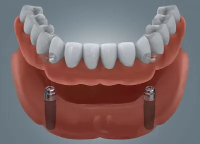 Покрывной зубной протез: какие бывают, как держатся, показания к установке