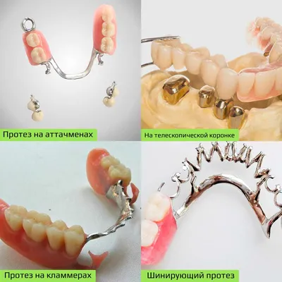 Бюгельный протез: виды, цена, отзывы | Гид по Стоматологии