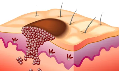 Рак кожи щеки | NEOPLASTY