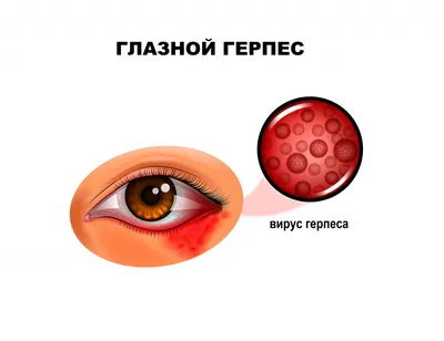 Блефарит: что это такое? Симптомы, причины, диагностика, лечение и  профилактика воспаление век