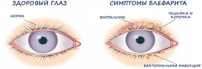 Блефарит: симптомы, причины, способы лечения - Prodex