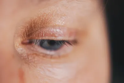 Блефарит глаз — диагностика и лечение по уникальной методике в ЦТО