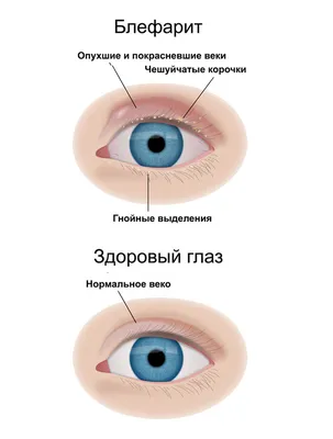 Блефарит: причины, симптомы, диагностика и лечение