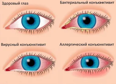 Сухость, воспаление и краснота в глазах. Как этого избежать? | Московское  здоровье | Дзен