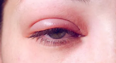 Блефарит — симптомы, лечение блефарита глаз у детей и взрослых