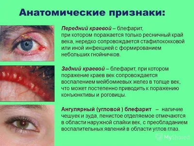Заболевания кожи вокруг глаз и век - РКОБ им. проф. Е.В. Адамюка