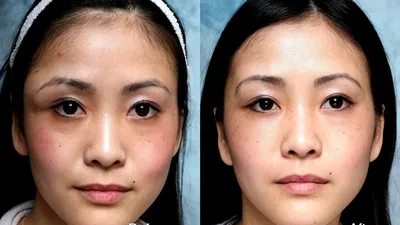 Блефаропластика азиатских век, цены, отзывы | Клиника Beauty Trend