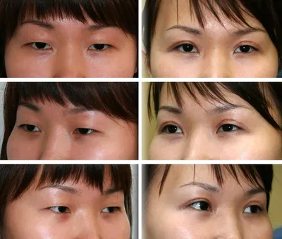 Блефаропластика азиатских глаз в Краснодаре - цены, отзывы, реальные фото  до и после | Пластический хирург Маркушин