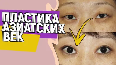 Пластическая операция азиатских глаз и удалении эпикантуса